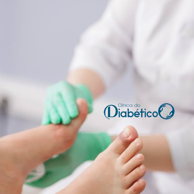 pe diabetico - tratamento de feridas e curativos especiais 21
