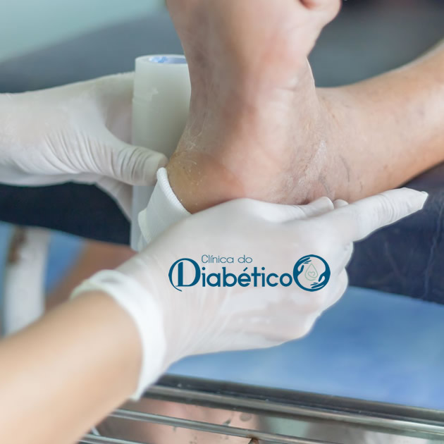 pe diabetico - tratamento de feridas e curativos especiais 22